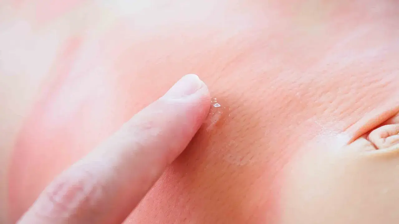 Un doigt touche délicatement un bouton de stress sur une peau rougie, peut-être après une exposition au soleil.