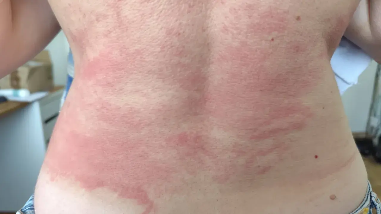 Plaques rouges et enflammées sur le dos d'un adulte, typiques d'une poussée d'eczéma.