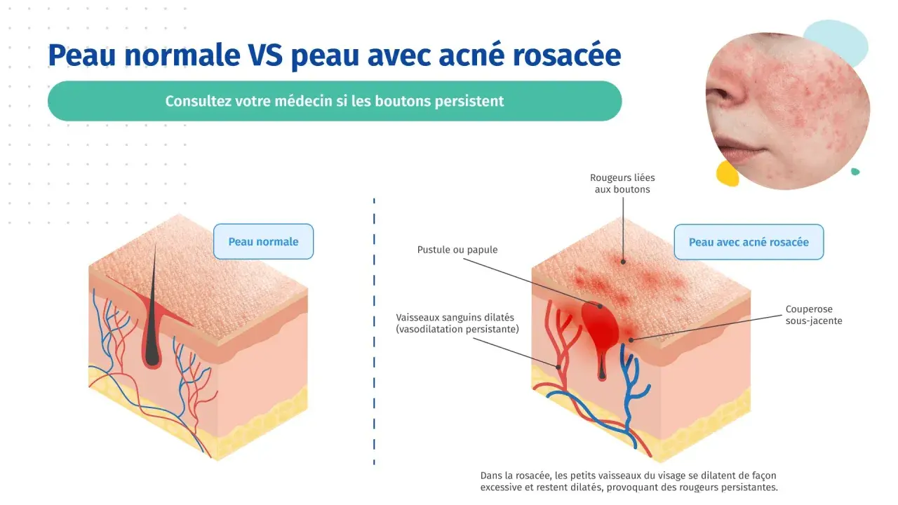 Comparaison peau normale et peau avec rosacée pustuleuse. L'image montre des pustules, rougeurs et vaisseaux dilatés caractéristiques de la rosacée.