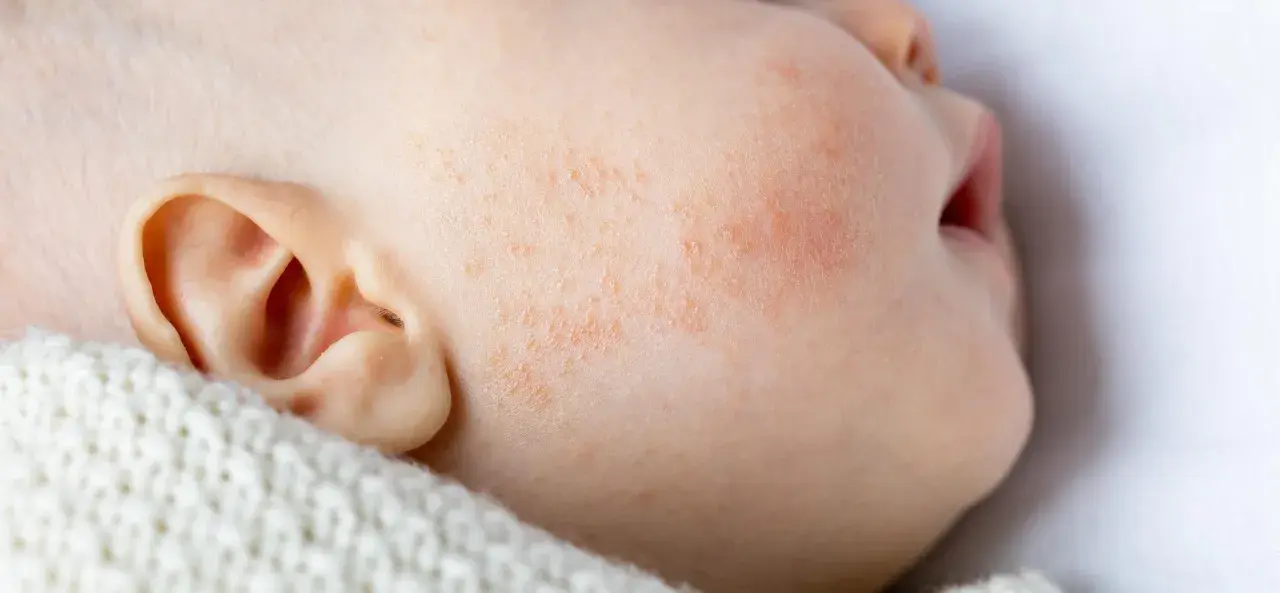 Gros plan sur la joue d'un bébé présentant des rougeurs et des petites plaques, signes d'eczéma bébé. La peau est irritée.