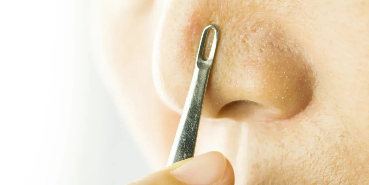 Un outil métallique est utilisé pour extraire un comédon fermé sur le nez.