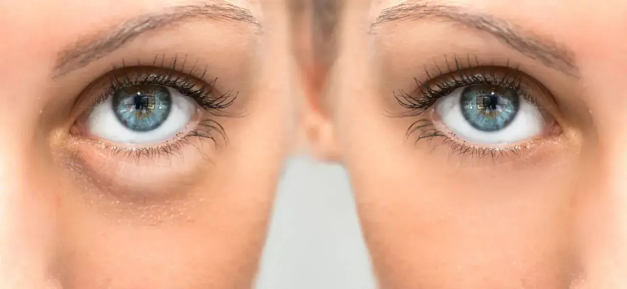 Gros plan sur des yeux bleus, montrant des poches sous les yeux. Le bicarbonate de soude est une astuce maison pour les atténuer.