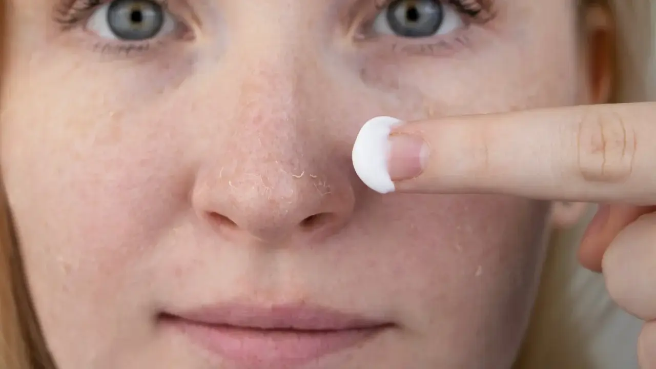 Une personne applique une crème sur son visage, montrant des zones de peau sèche et squameuse, typiques du psoriasis du visage.