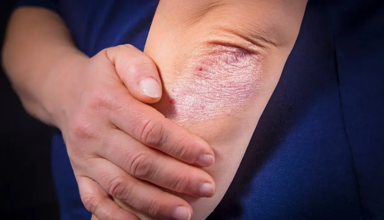 Psoriasis sur le coude, une affection cutanée rouge et squameuse. La main d'une personne touche doucement la zone affectée.