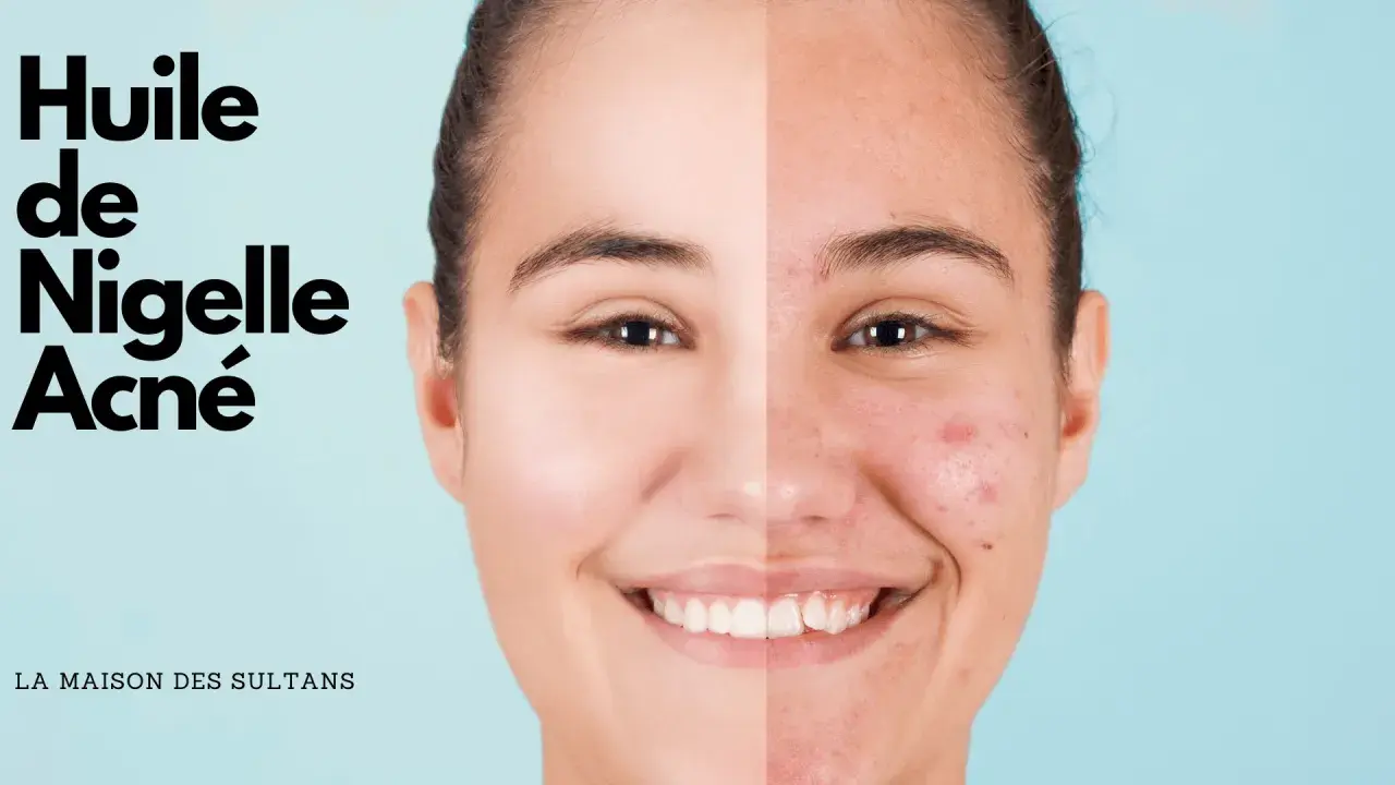 Visage divisé montrant une peau nette et une peau acnéique, avec le texte "Huile de Nigelle Acné".