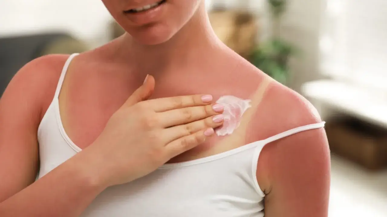 Une femme applique une crème apaisante sur son coup de soleil. Le Cicalfate aide à soulager la peau irritée.