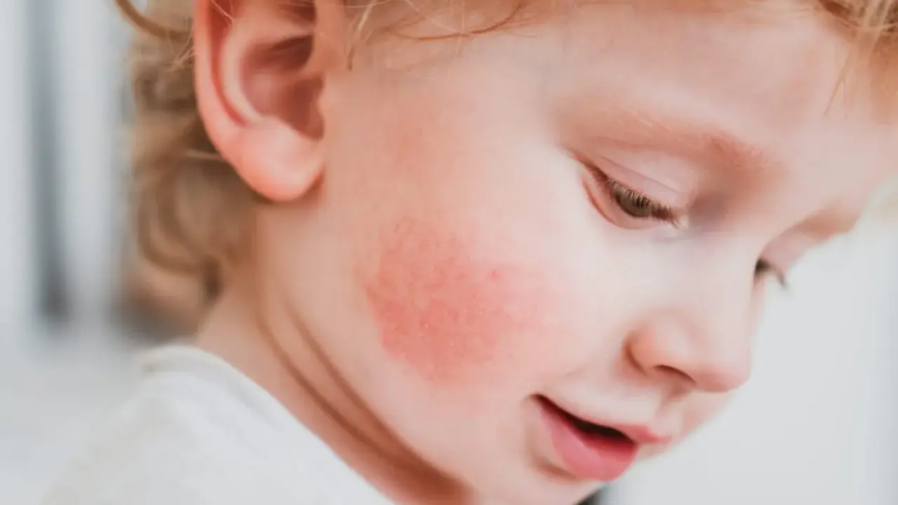 Un enfant avec une rougeur sur la joue, possiblement du pityriasis alba.