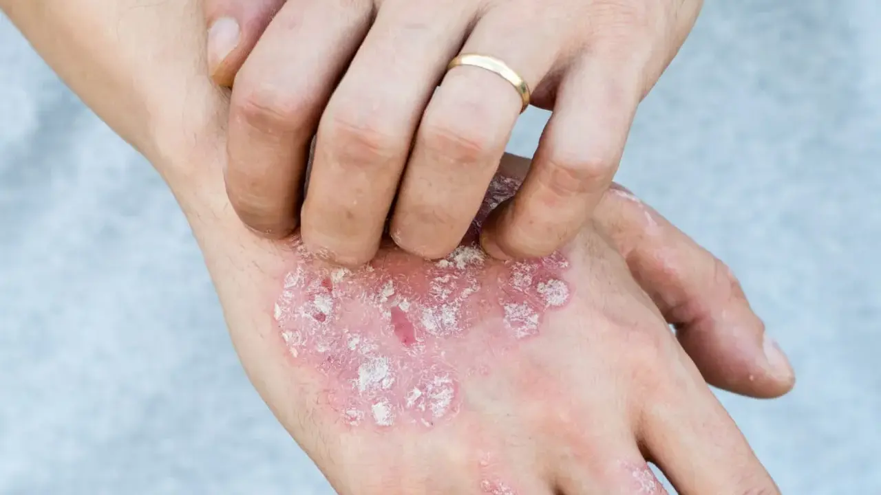 Main d'une personne se grattant des plaques rouges et squameuses, possiblement liées au psoriasis en goutte.