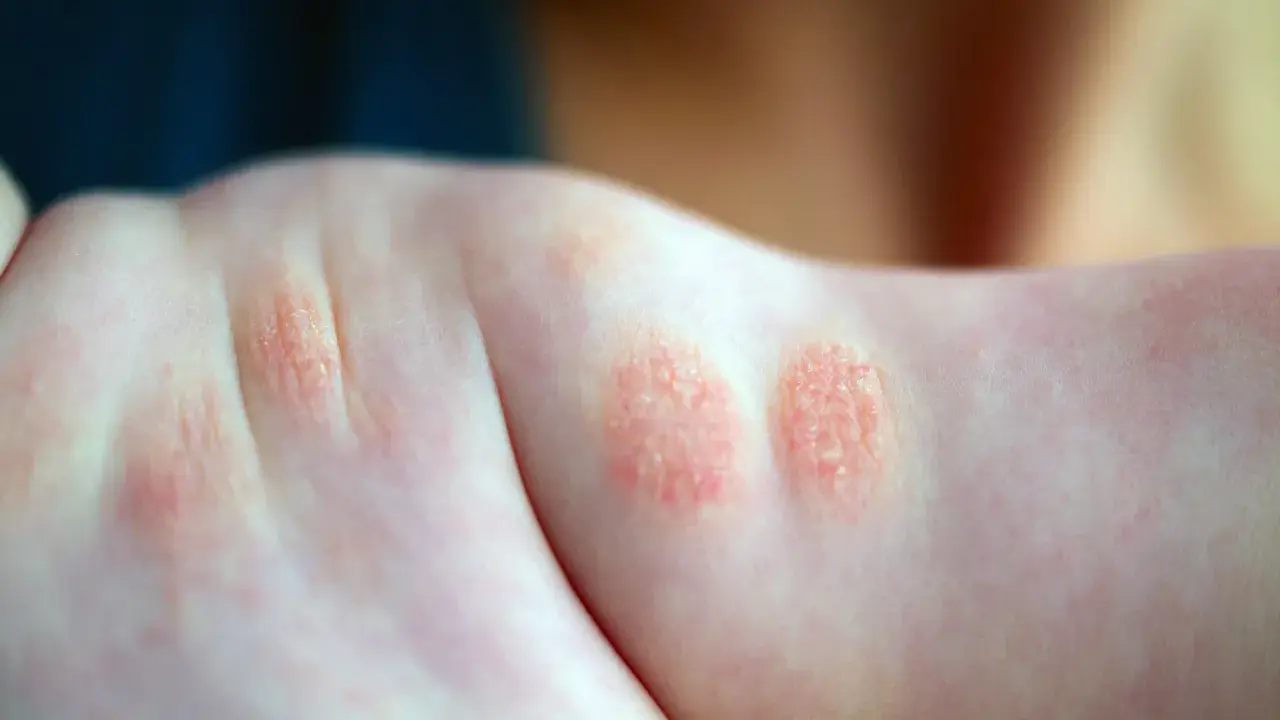 Plaques rouges et squameuses sur le bras d'un enfant, signe d'un petit bouton sur les bras allergie.