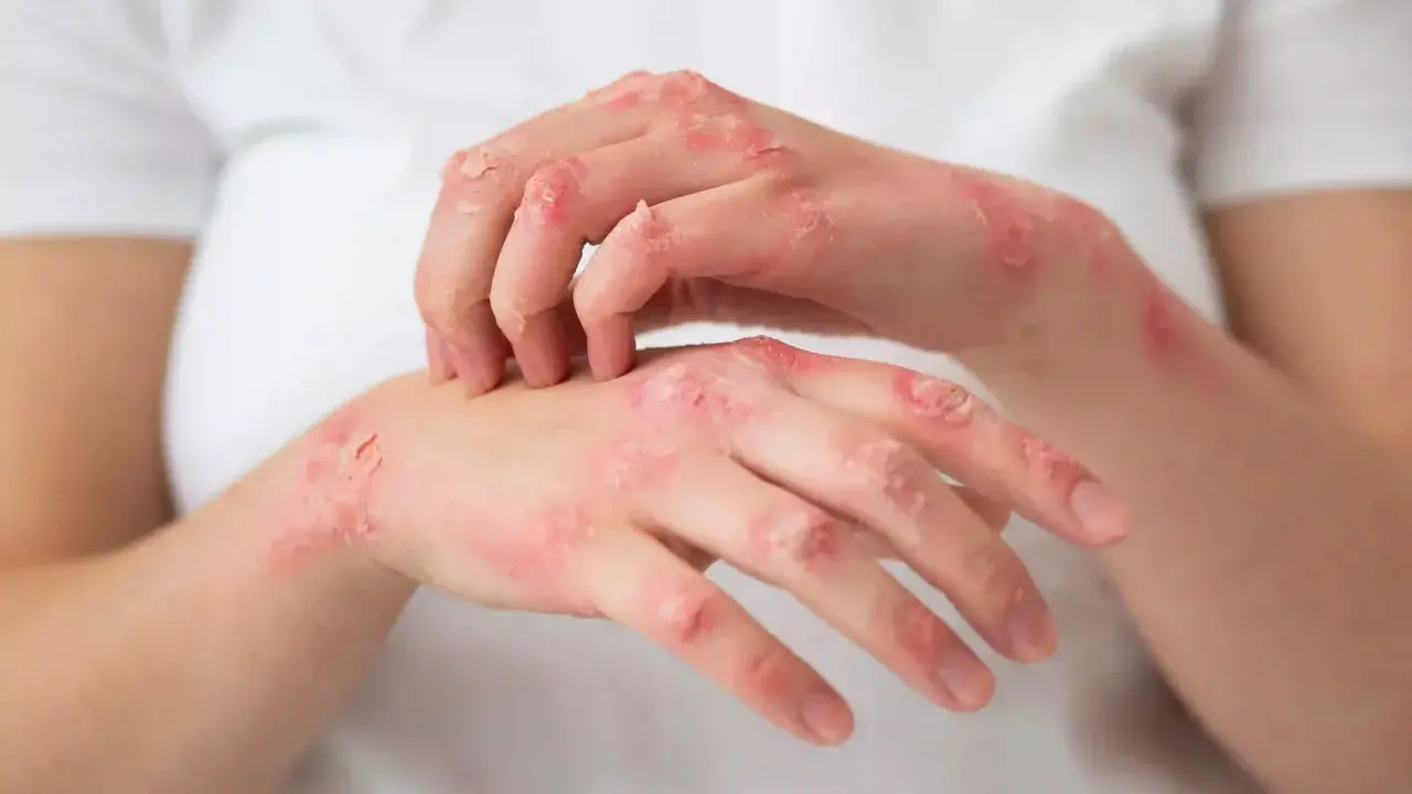 Mains atteintes de plaques rouges et squameuses, signe d'un psoriasis. La cause exacte reste complexe.