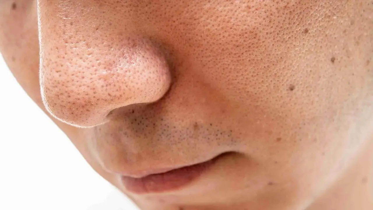 Gros plan sur le nez et la bouche, révélant une peau texturée avec de nombreux pores et un point noir spectaculaire.