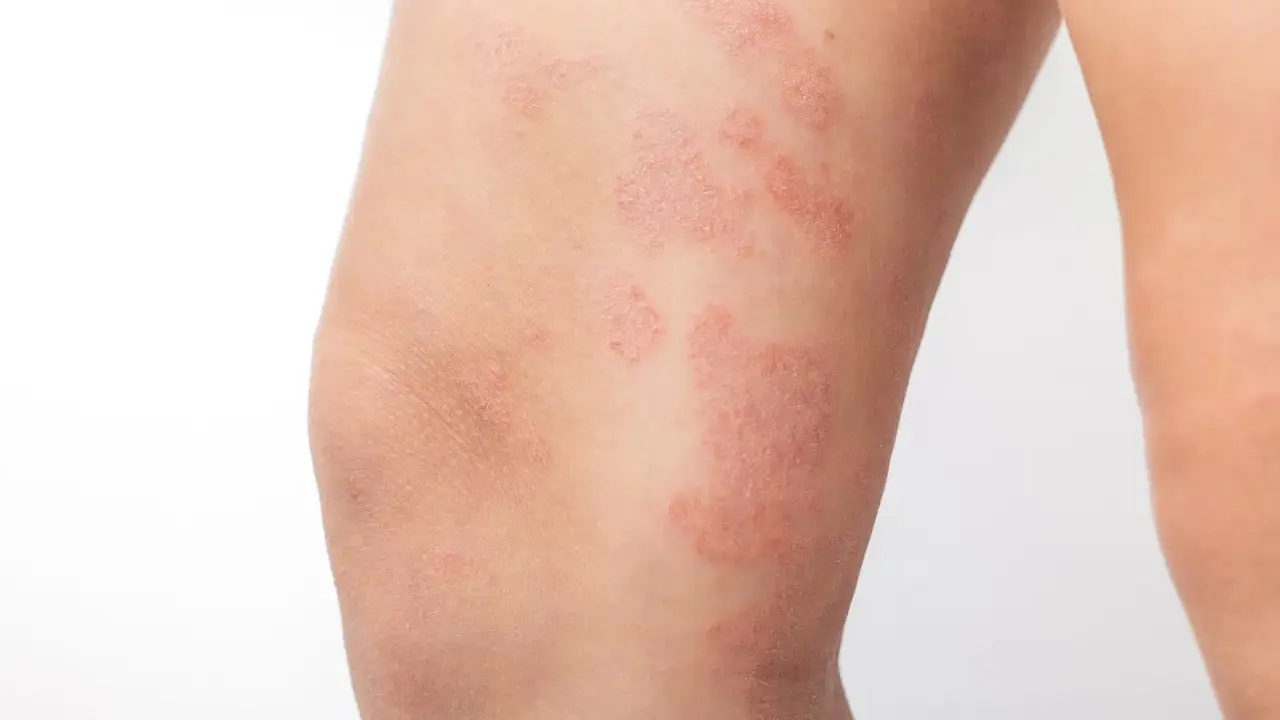 Plaques rouges et squameuses sur la cuisse, indiquant un **eczéma cuisse**. La peau semble irritée et sèche.