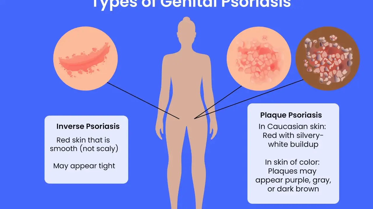 Illustration des types de psoriasis génital, y compris le psoriasis inversé et le psoriasis en plaques, qui peuvent affecter le pénis.