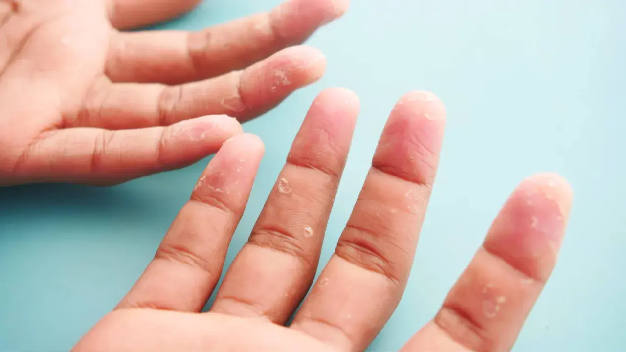 Mains affectées par la dyshidrose, avec des vésicules et une peau qui pèle sur les doigts.