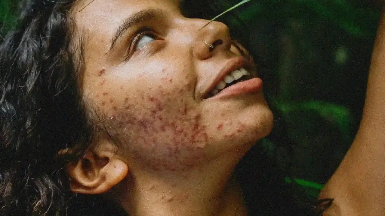 Visage d'une jeune femme aux cheveux sombres, le regard levé, présentant une acné inflammatoire marquée sur la joue et le cou. Une feuille verte effleure son front.
