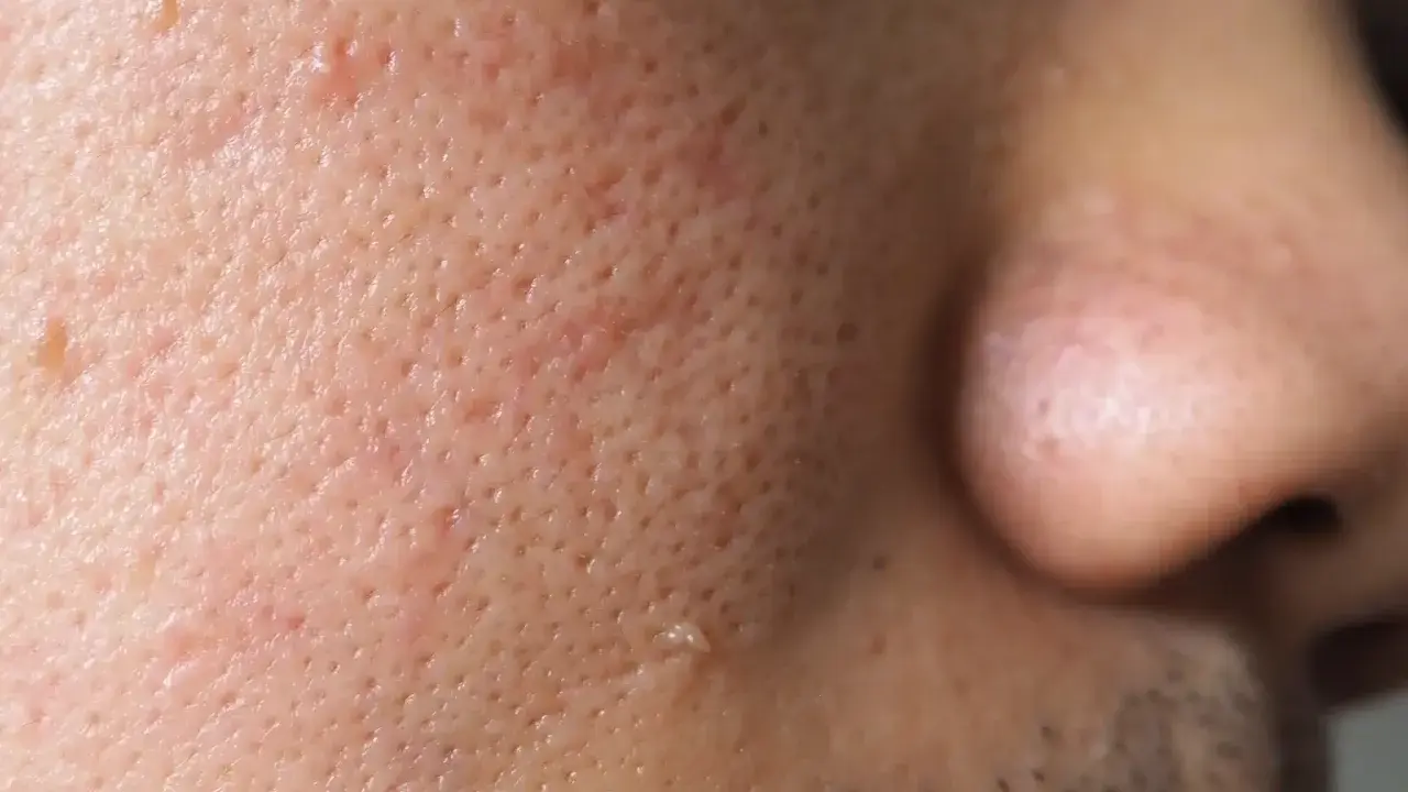 Gros plan sur la peau d'un visage, montrant des pores dilatés et une petite verrue sur la joue.