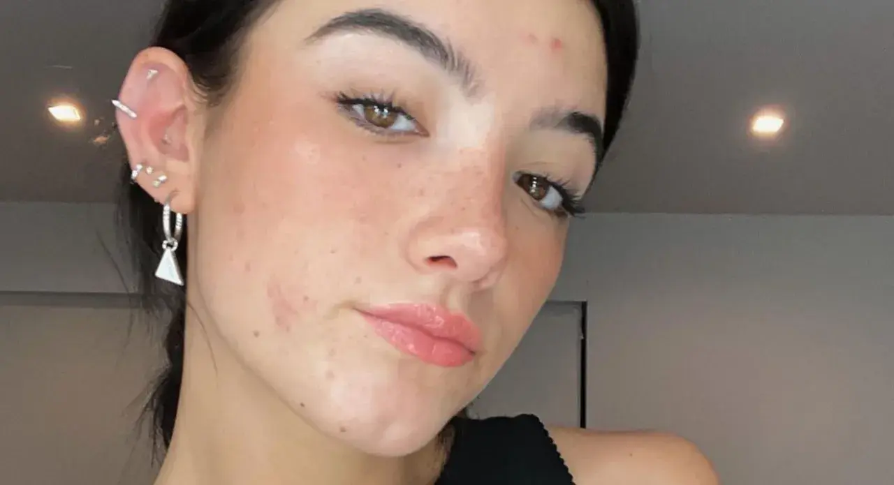 Gros plan sur le visage d'une jeune femme aux yeux marron, avec un bouton sur le front et des boucles d'oreilles.