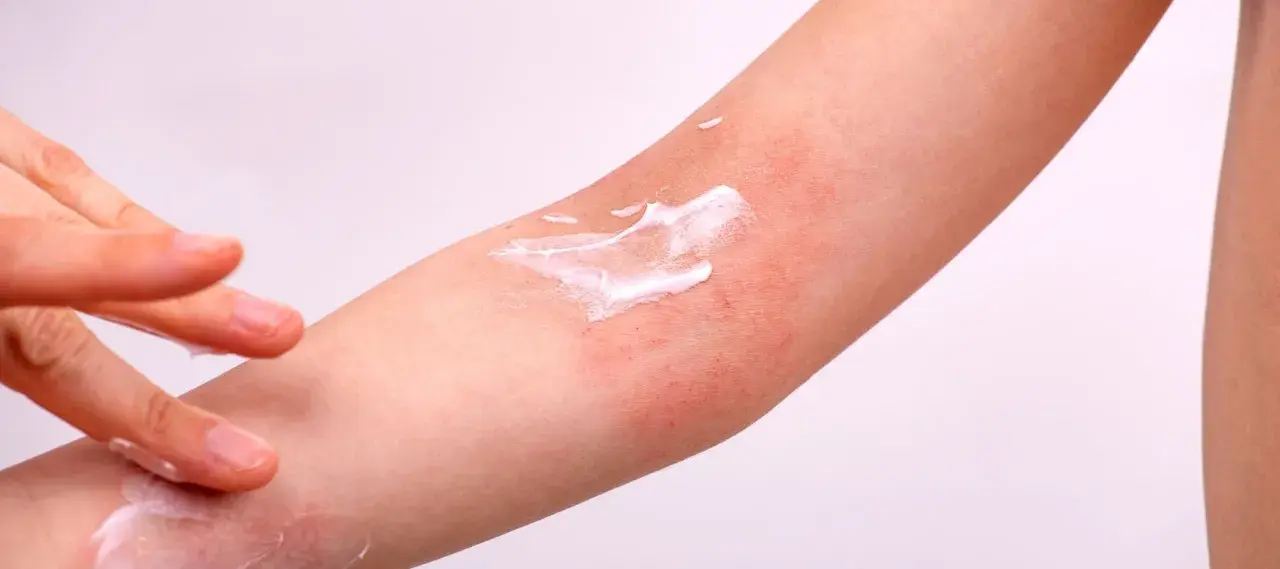 Application de crème sur une peau rouge et irritée, symptôme de dermatite atopique.