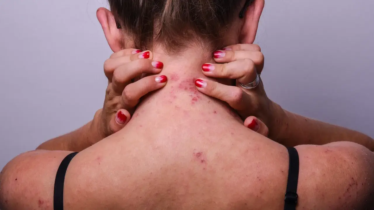 Vue arrière d'une personne se grattant le cou et le haut du dos, montrant des rougeurs et des irritations dues à l'eczéma.