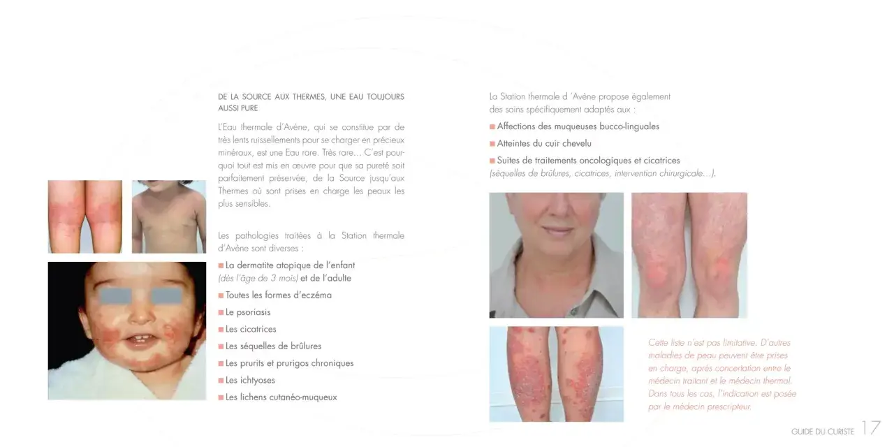 La Station thermale d'Avène traite diverses pathologies cutanées, comme l'eczéma et le psoriasis, illustrées par des photos.