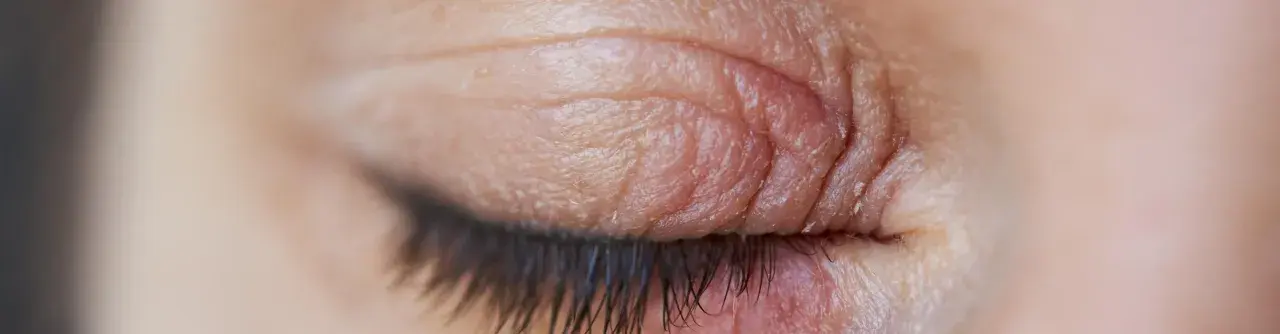 Gros plan sur un œil fermé, montrant la peau irritée et squameuse typique de l'eczéma paupière.