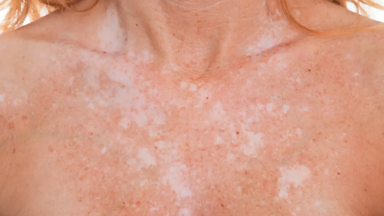 Poitrine et cou d'une personne avec une peau tachetée, montrant des zones de pigmentation inégale dues à l'exposition au soleil.