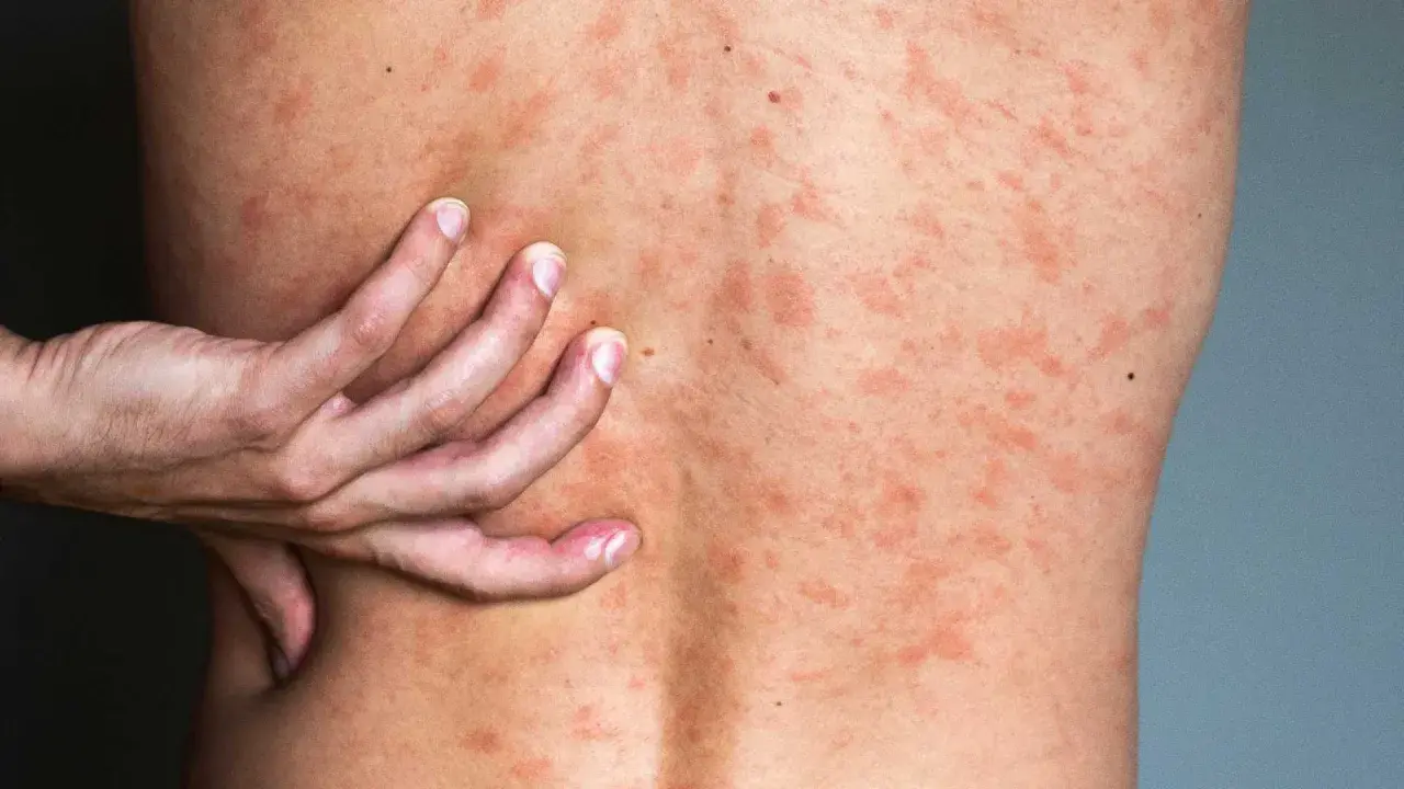 Une main gratte le dos couvert de plaques rouges, signe d'urticaire due au stress.
