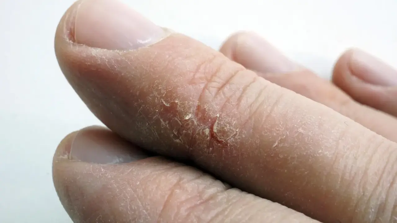 Gros plan sur des doigts montrant une peau sèche et craquelée, avec une crevasse visible sur un doigt.