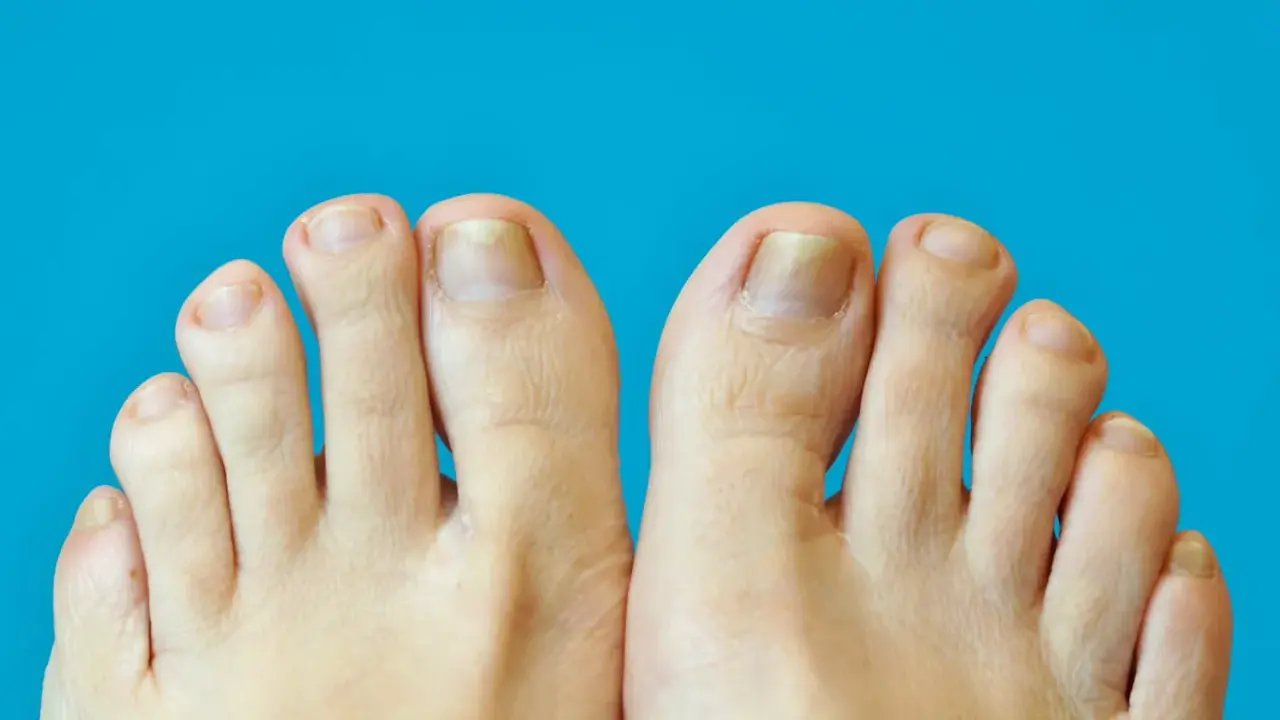 Gros plan sur des pieds montrant des ongles jaunis et épaissis, symptômes possibles de psoriasis ongle pied.