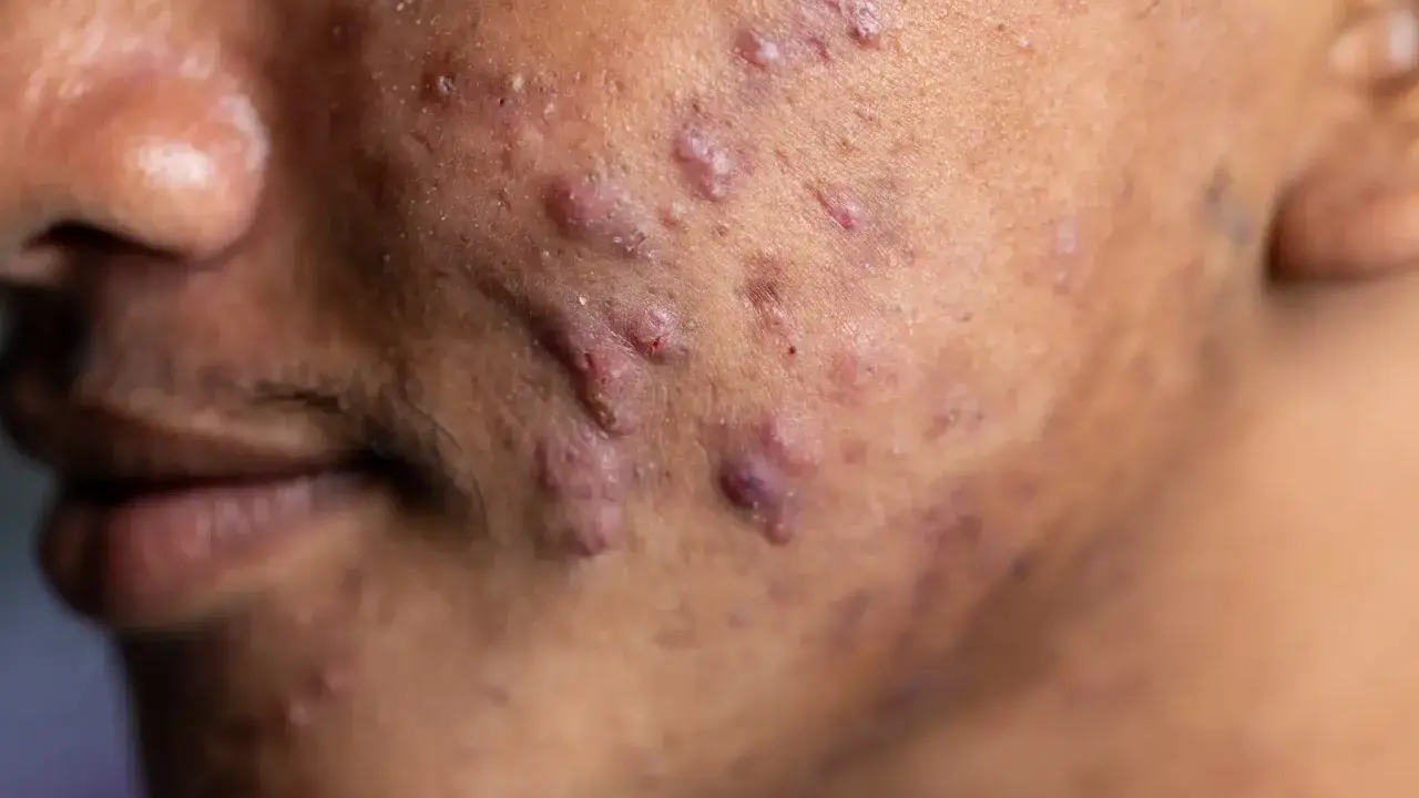 Gros plan sur une peau marquée par de nombreux boutons d'acné, dont un acné nodule particulièrement visible.