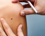 Examen d'un grain de beauté sur l'épaule, un médecin utilise un stylo pour le marquer.