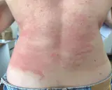 Plaques rouges et enflammées sur le dos d'un adulte, typiques d'une poussée d'eczéma.