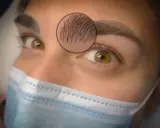 Gros plan sur un œil et un sourcil, avec un zoom sur une fine cicatrice au sourcil, cachée par quelques poils.