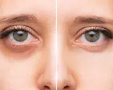 Comparaison avant/après : des yeux fatigués avec des cernes prononcés à des yeux reposés et lumineux.
