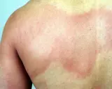 Plaques rouges et surélevées sur le dos, typiques d'une urticaire chaleur.