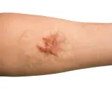 Gros plan sur un bras humain montrant une cicatrice hypertrophique, surélevée et rosée, témoignant d'une guérison cutanée complexe.