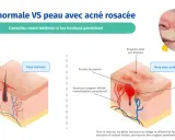 Comparaison peau normale et peau avec rosacée pustuleuse. L'image montre des pustules, rougeurs et vaisseaux dilatés caractéristiques de la rosacée.