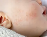 Gros plan sur la joue d'un bébé présentant des rougeurs et des petites plaques, signes d'eczéma bébé. La peau est irritée.