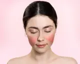 Visage d'une jeune femme aux joues marquées par une plaque rouge, les yeux fermés, sur fond rose doux.
