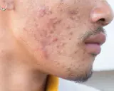 Gros plan sur le visage d'un homme présentant une acné sévère, avec des rougeurs et des pustules visibles sur la joue et le menton.