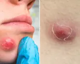 Gros bouton sous la peau douloureux, rouge et enflammé, près de la bouche, et un autre sur la peau.