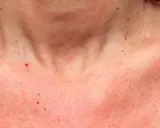 Peau rougie et tachetée sur le cou et le décolleté, comme un visage qui aurait pris un coup de soleil.