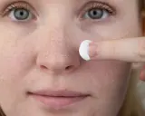 Une personne applique une crème sur son visage, montrant des zones de peau sèche et squameuse, typiques du psoriasis du visage.