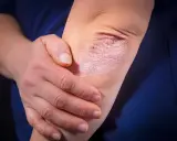 Psoriasis sur le coude, une affection cutanée rouge et squameuse. La main d'une personne touche doucement la zone affectée.