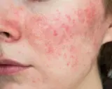 Gros plan sur une peau rougie avec des rougeurs et des petites papules sur le visage, près du nez et de la bouche.