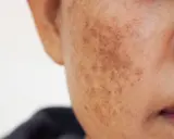 Gros plan sur une joue montrant une tache brune sur la peau, résultat d'une hyperpigmentation.