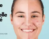 Visage divisé montrant une peau nette et une peau acnéique, avec le texte "Huile de Nigelle Acné".