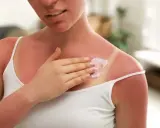 Une femme applique une crème apaisante sur son coup de soleil. Le Cicalfate aide à soulager la peau irritée.
