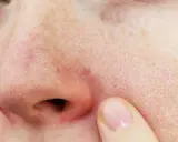 Gros plan sur un nez avec une légère rougeur autour des narines et des pores visibles. Un doigt effleure la peau.
