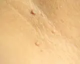 Gros plan sur une peau claire montrant plusieurs petites excroissances cutanées, certaines ressemblant à des grains de beauté ou des verrues.